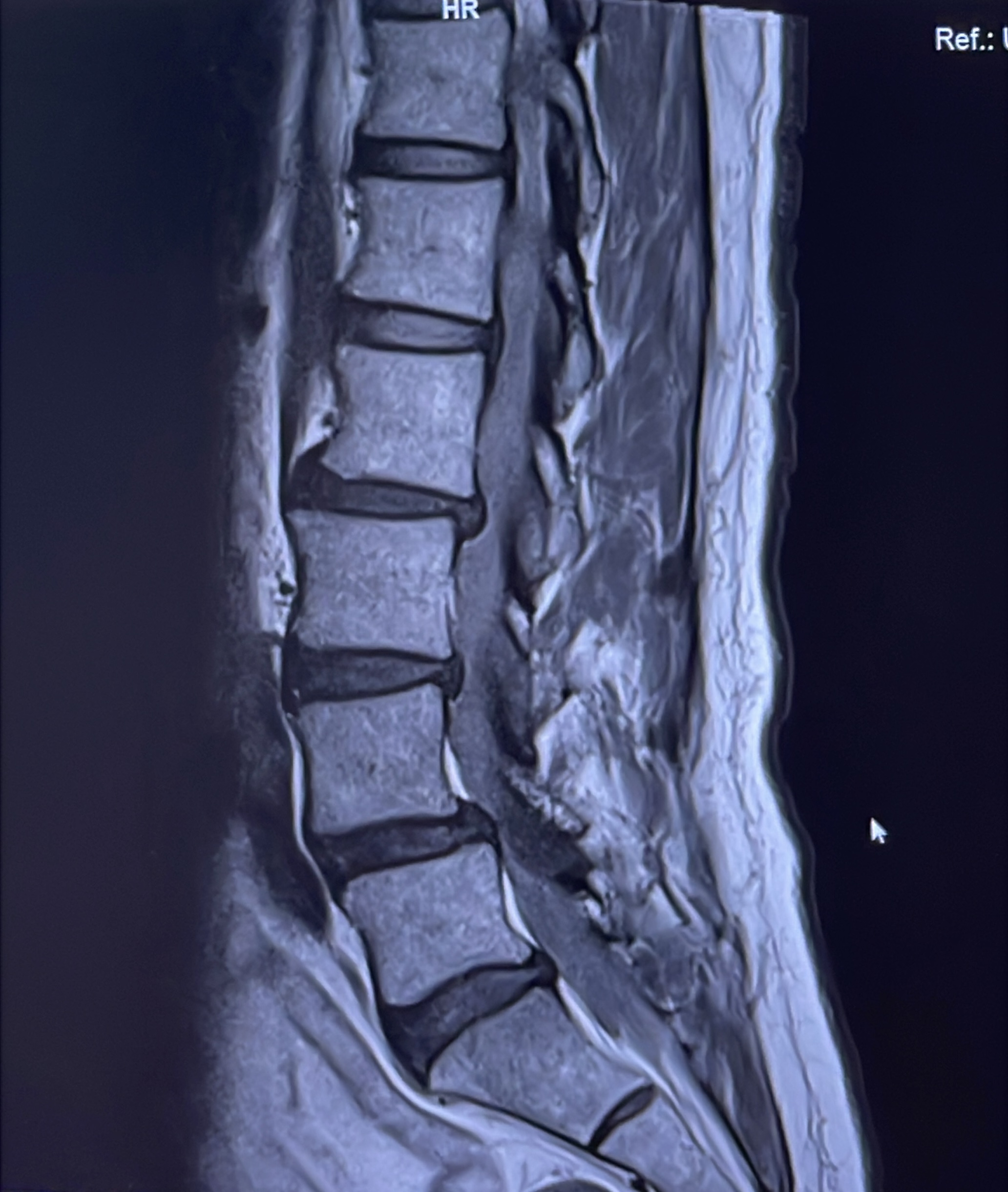 หมอนรองกระดูกเสื่อม… ต้องทำ MRI ไหม? เอกซเรย์พอหรือเปล่า?