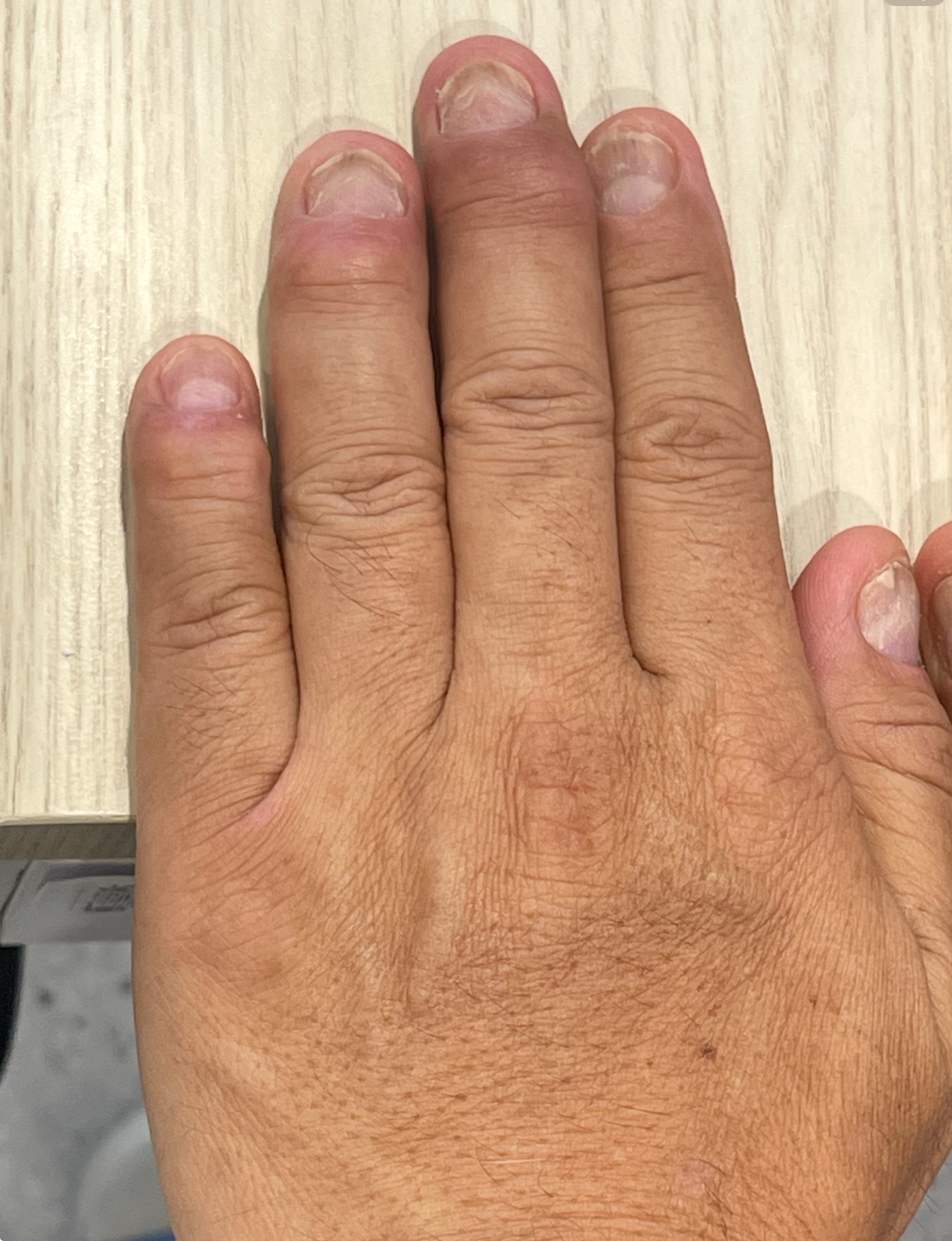 ปวดข้อนิ้วมือ ปลายข้อโป่งแข็ง OA ข้อนิ้วมือ (DIP)