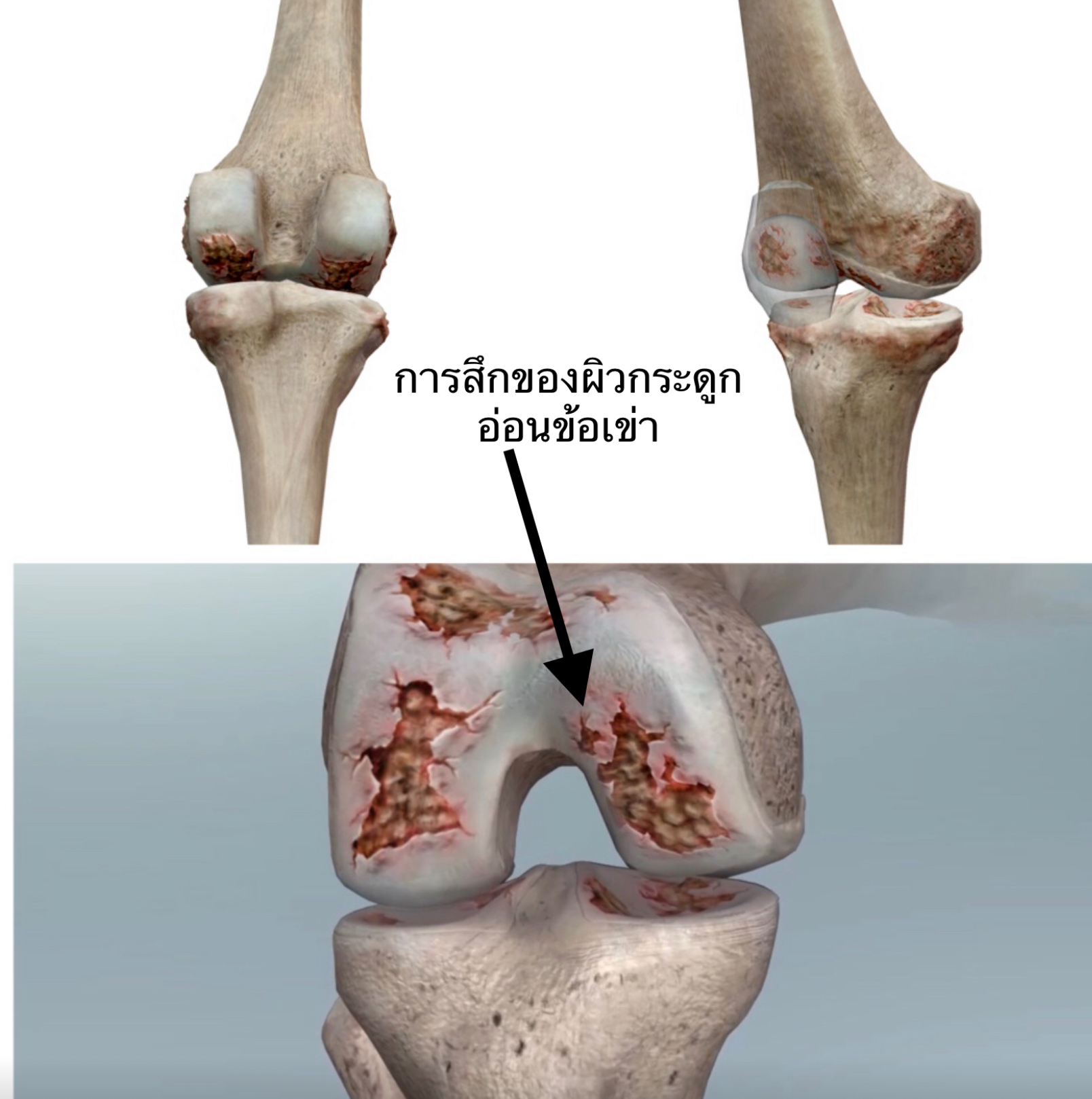 ปวดเข่าจากโรคข้อเข่าเสื่อม เข้าใจให้ถูก ดูแลได้ทัน