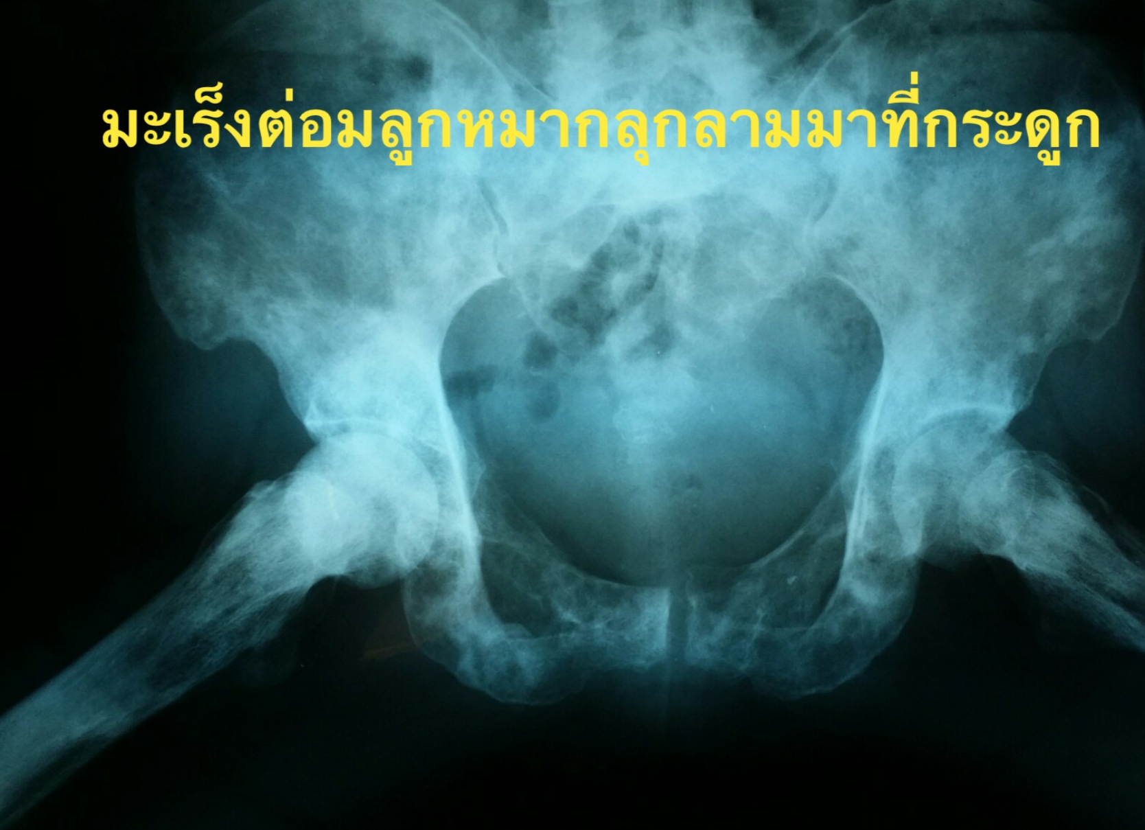 ปวดหลัง ปวดสะโพกในผู้ชายสูงอายุ อย่ามองข้าม เพราะอาจซ่อนมะเร็งต่อมลูกหมากลามกระดูกไว้่