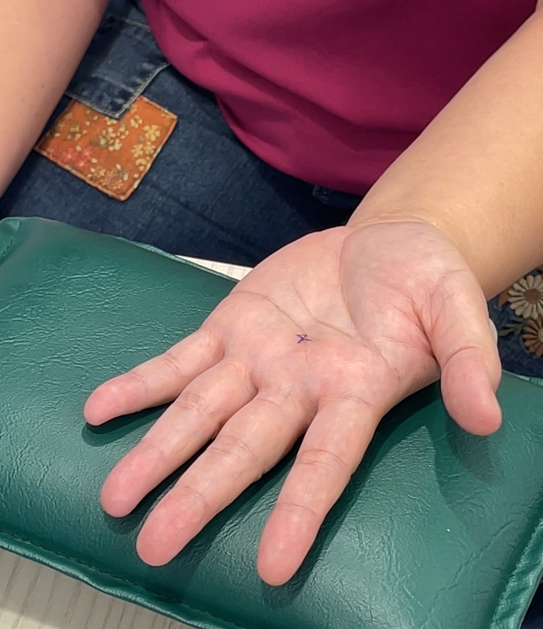 มือชาไม่ใช่แค่ปวดเมื่อย! ระวัง “พังผืดทับเส้นประสาท” ซ่อนอยู่ไม่รู้ตัว