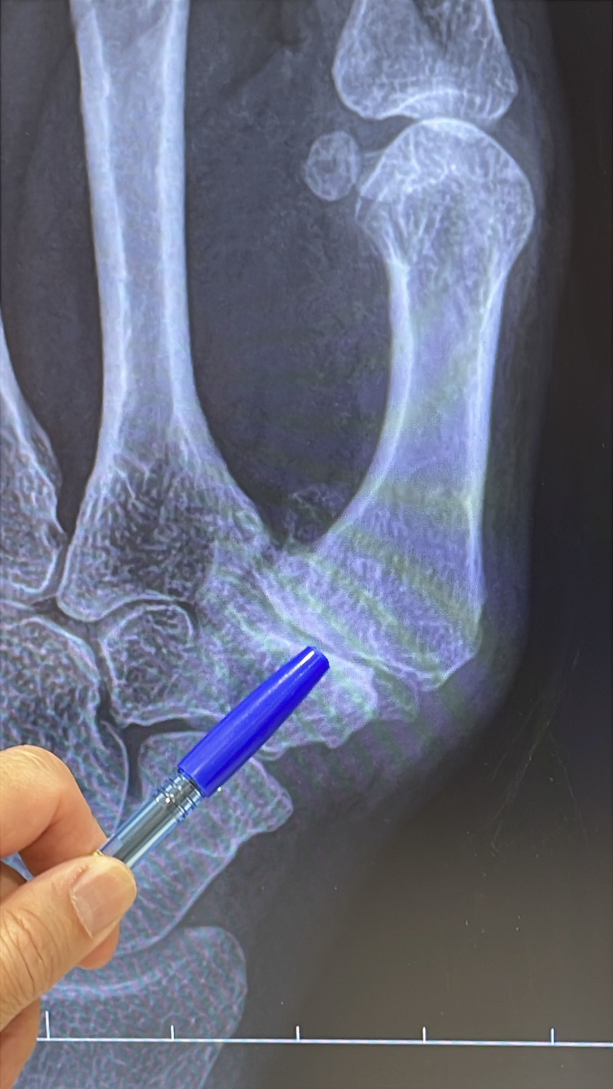 ปวดโคนนิ้วโป้ง หยิบของแล้วเจ็บ... ระวังข้อเสื่อมโคนนิ้วโป้ง (1st CMC Joint Osteoarthritis)
