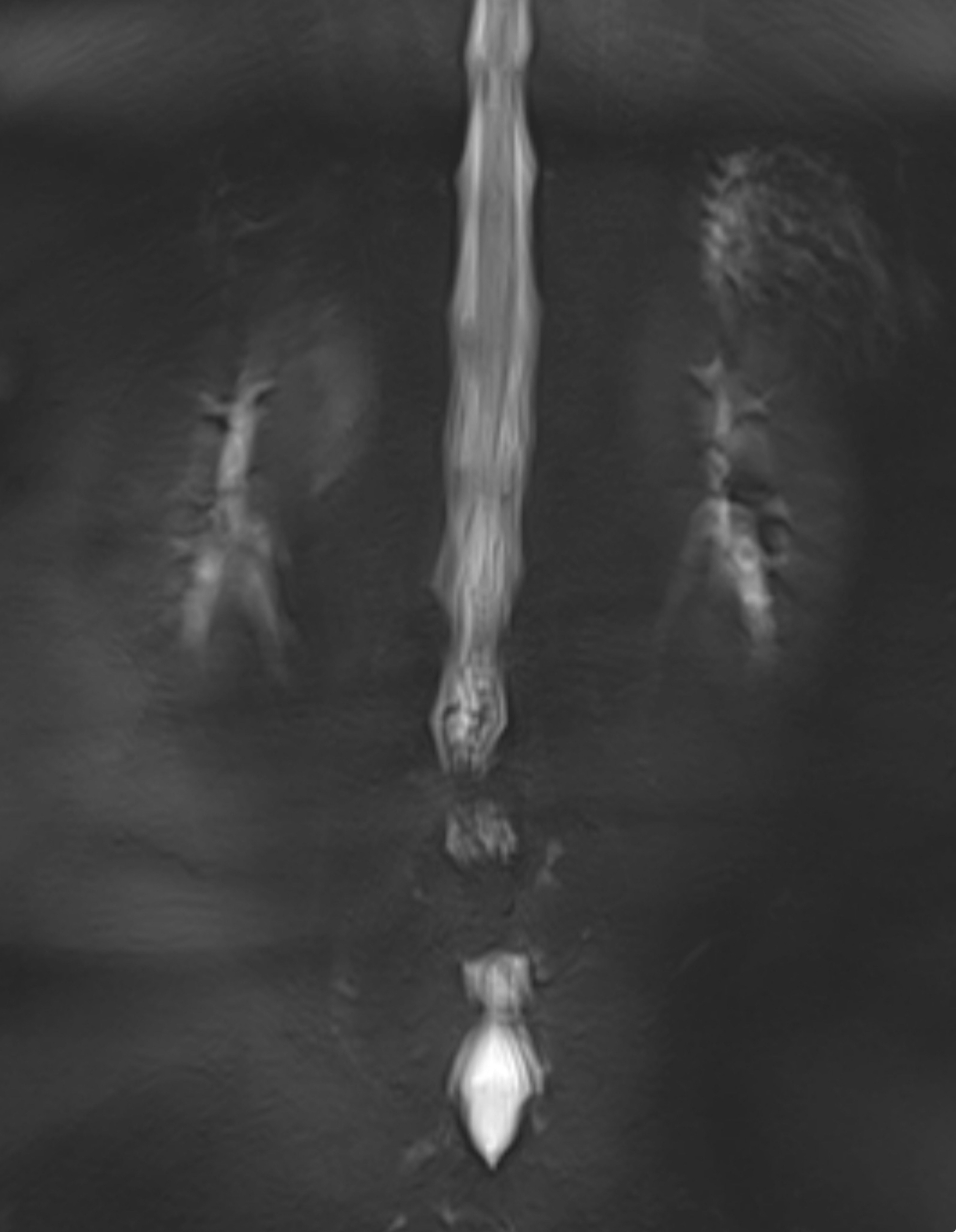 ปวดหลัง ก้าวขาไม่ออก (Spinal Canal Stenosis) จำเป็นต้องผ่าตัด?
