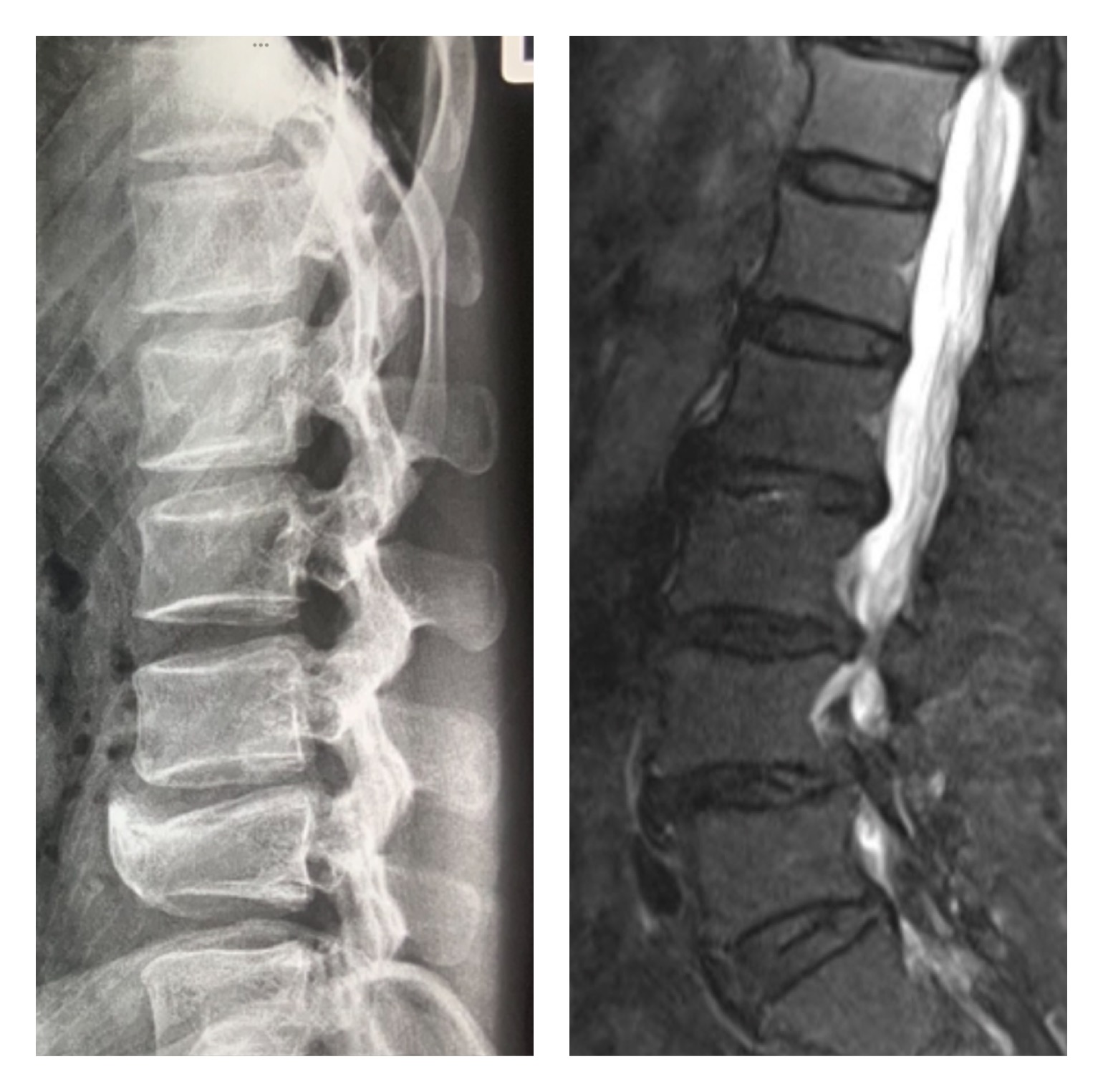MRI สำคัญกว่าการเอกซเรย์อย่างไรในการตรวจโรคปวดหลัง