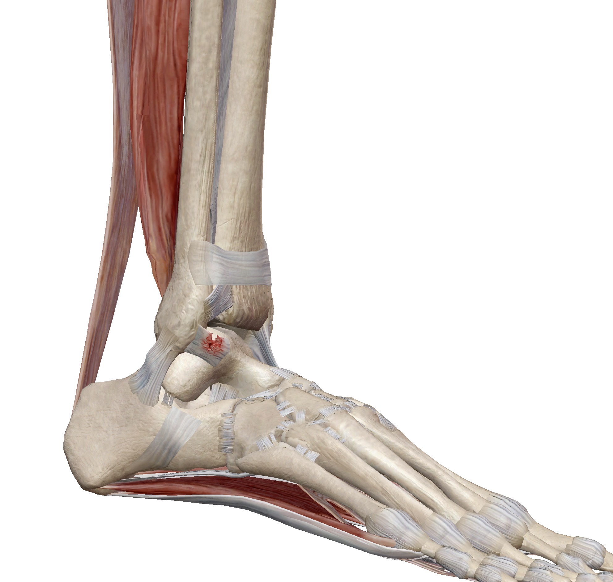 ข้อเท้าพลิก (Ankle sprain) — เรื่องเล็กที่อาจกลายเป็นเรื่องใหญ่ ถ้าปล่อยไว้ไม่รักษา