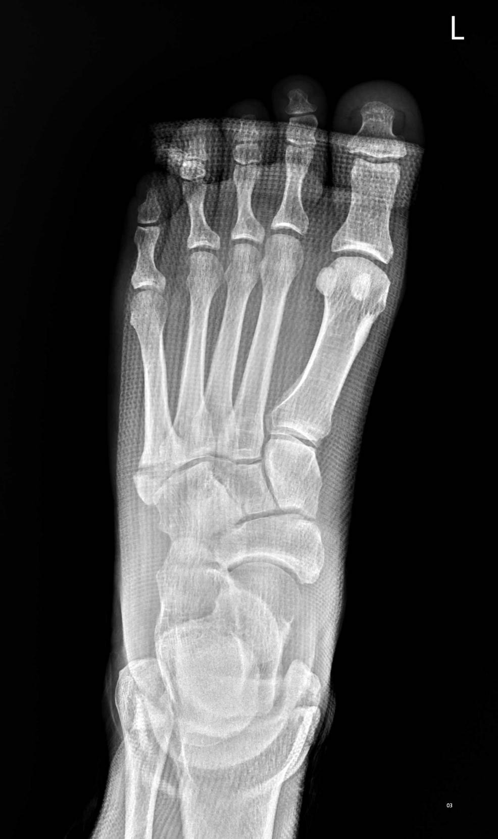 หกล้ม ข้อเท้าพลิก แล้วเจ็บข้างเท้า — หมออยากให้ระวัง “Jones Fracture” กระดูกฝ่าเท้าชิ้นที่ 5 หักตำแหน่งพิเศษที่หายยาก!