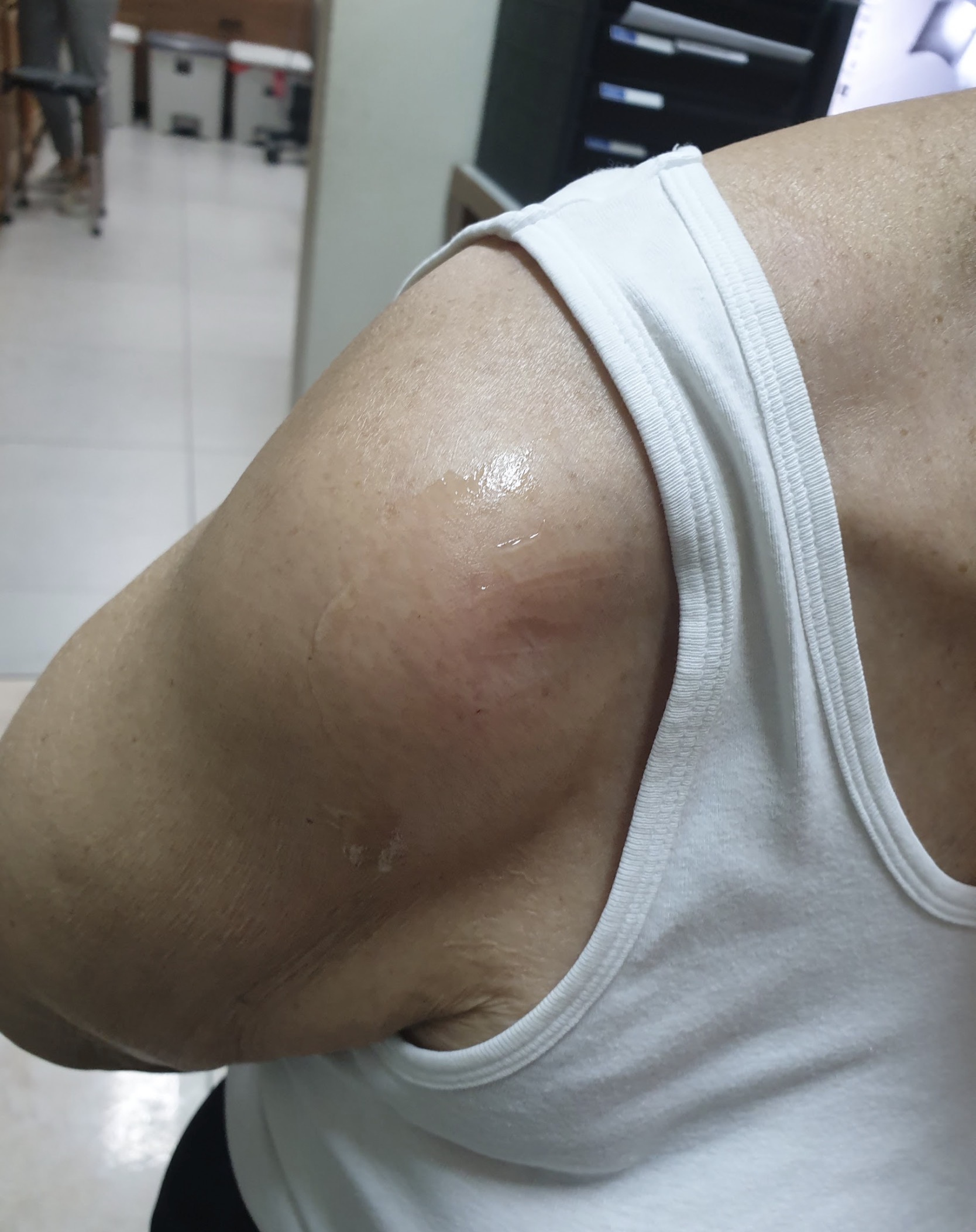 ไหล่หลุด รักษาอย่างไร? เข้าใจสาเหตุ อาการ และวิธีดูแลให้ไหล่กลับมาแข็งแรง