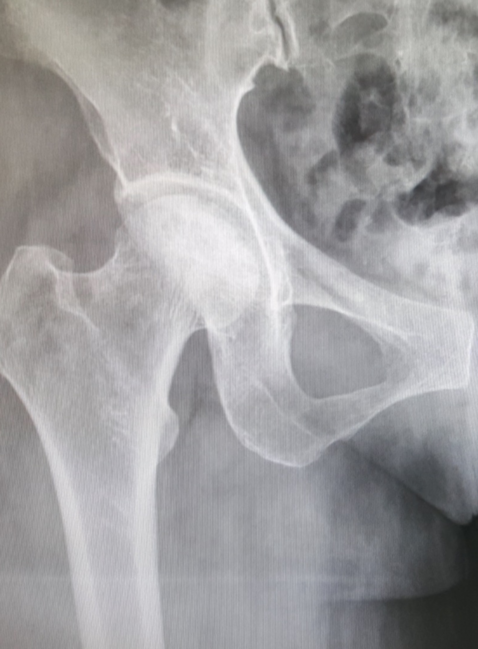 Core Decompression การรักษา AVN ของสะโพก: วิธีชะลอการยุบของหัวกระดูกที่ได้ผลดีที่สุดในระยะต้น