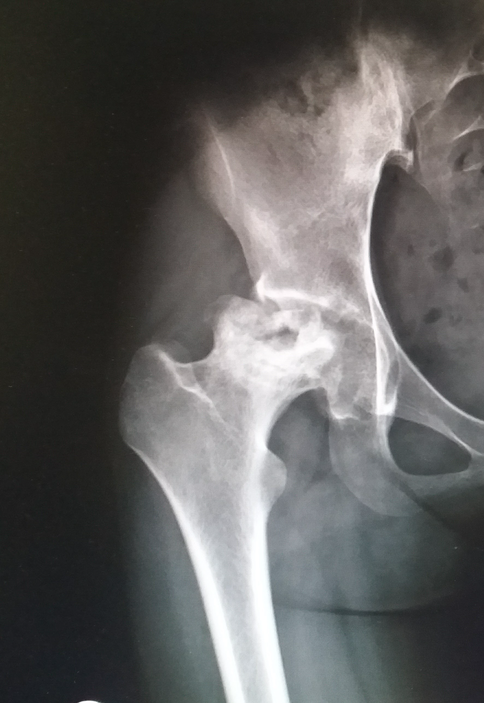 ผ่าตัดเปลี่ยนข้อสะโพกเทียม (Total Hip Replacement: THR) ในผู้ป่วย AVN ระยะที่ 4 — ทางรอดของข้อสะโพกที่ยุบตัวแล้ว