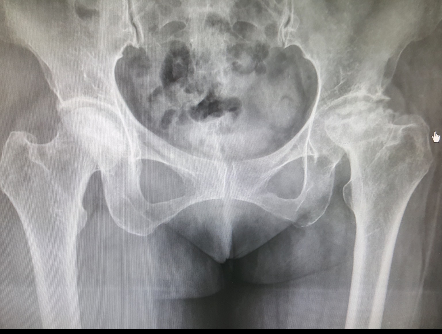 Avascular Necrosis (AVN) of the Hip — กระดูกสะโพกขาดเลือด ภัยเงียบที่รักษาได้ถ้าพบเร็ว
