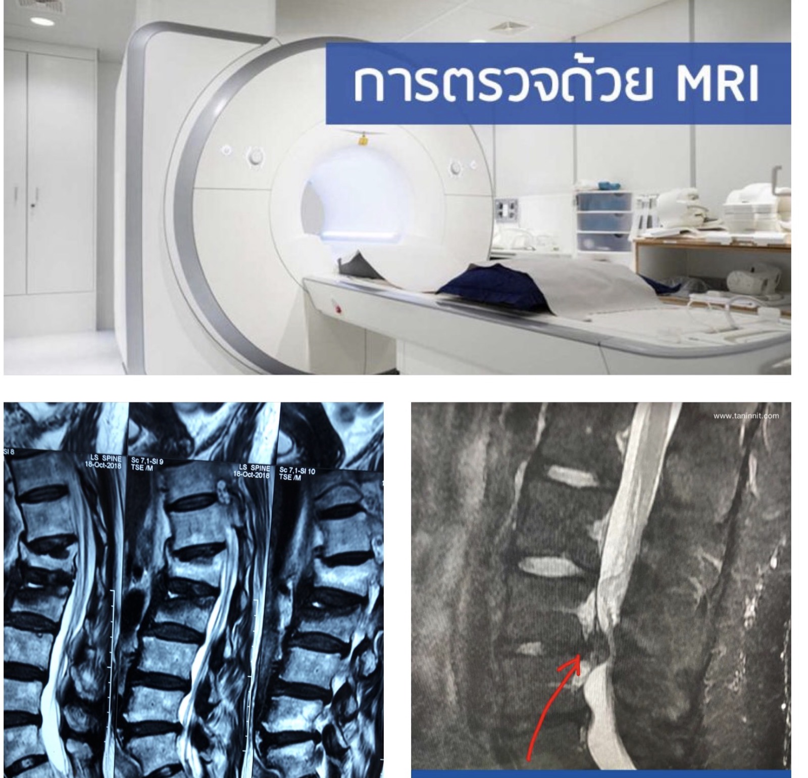 MRI คืออะไร? ตรวจเมื่อไหร่? และมีประโยชน์อย่างไรในโรคกระดูกและข้อ