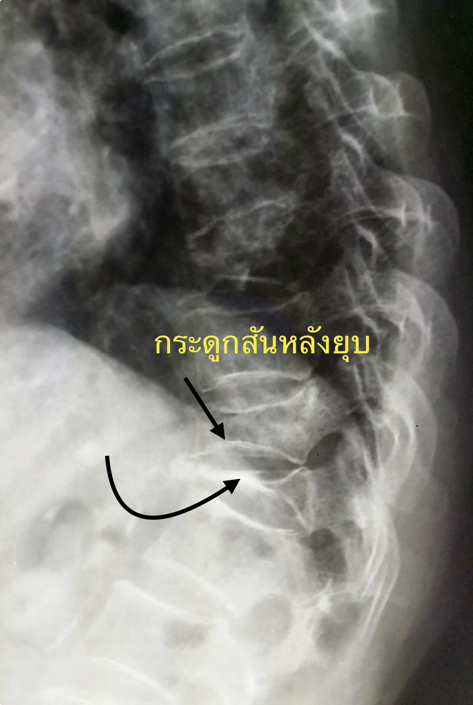 ปวดหลังจาก “กระดูกสันหลังยุบ” เพราะกระดูกพรุน — ทำไมถึงปวดมาก? และรักษาอย่างไรให้หายเร็วและปลอดภัย