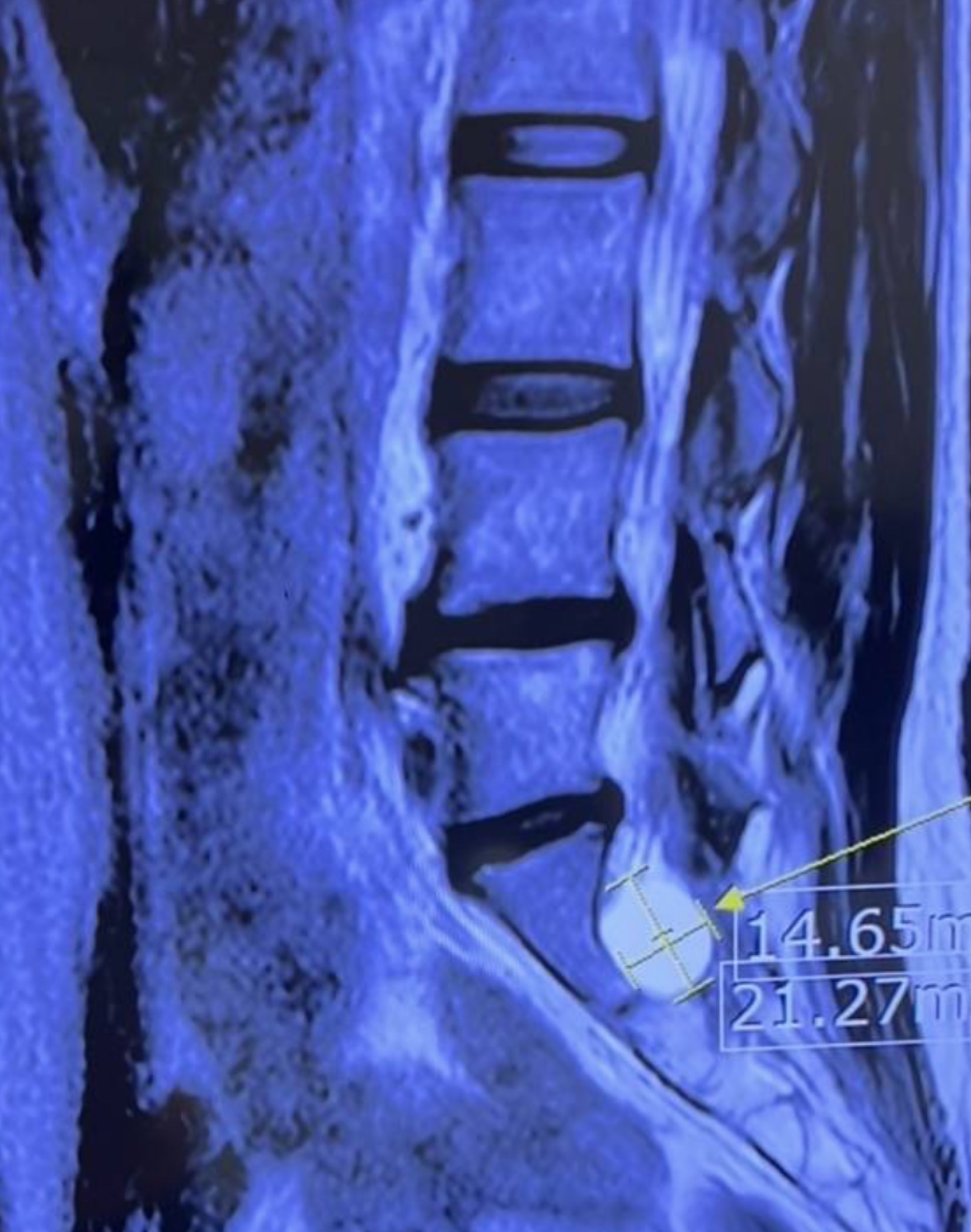 ปวดหลัง  MRI เจอ Tarlov cyst = ต้องรีบรักษา?