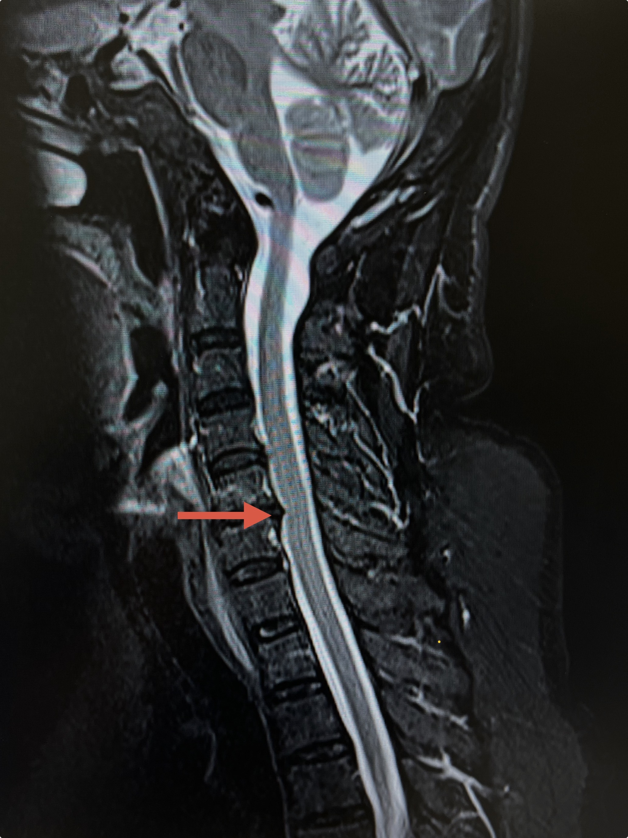 ทำ MRI แล้วพบว่า 'หมอนรองกระดูกทับเส้นประสาท' ... ต้องจบที่ห้องผ่าตัดทุกรายจริงหรือ?"
