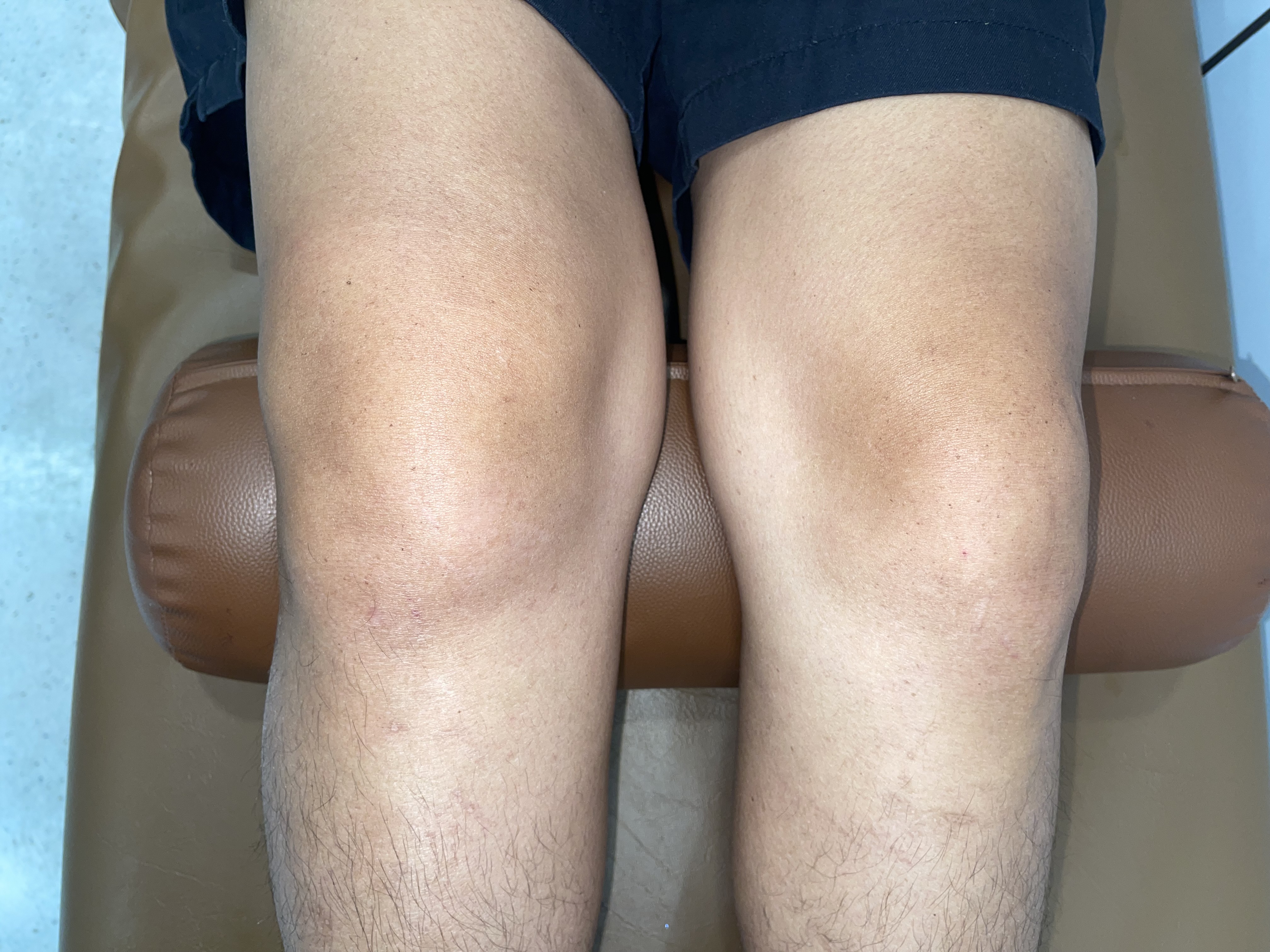 อายุ 40–50 ปี เข่าเสื่อมได้จริงหรือ?