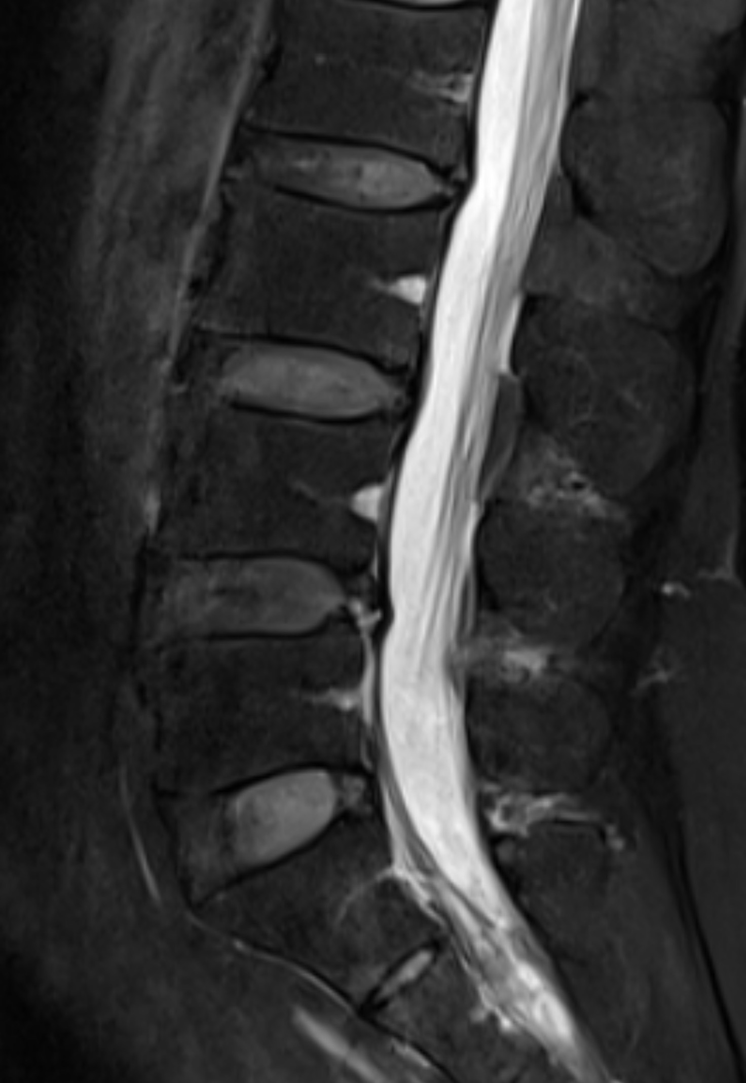 ปวดหลังต้องทำ MRI ทุกคนไหม? หลายคนรีบทำ MRI ทั้งที่ยังไม่จำเป็น