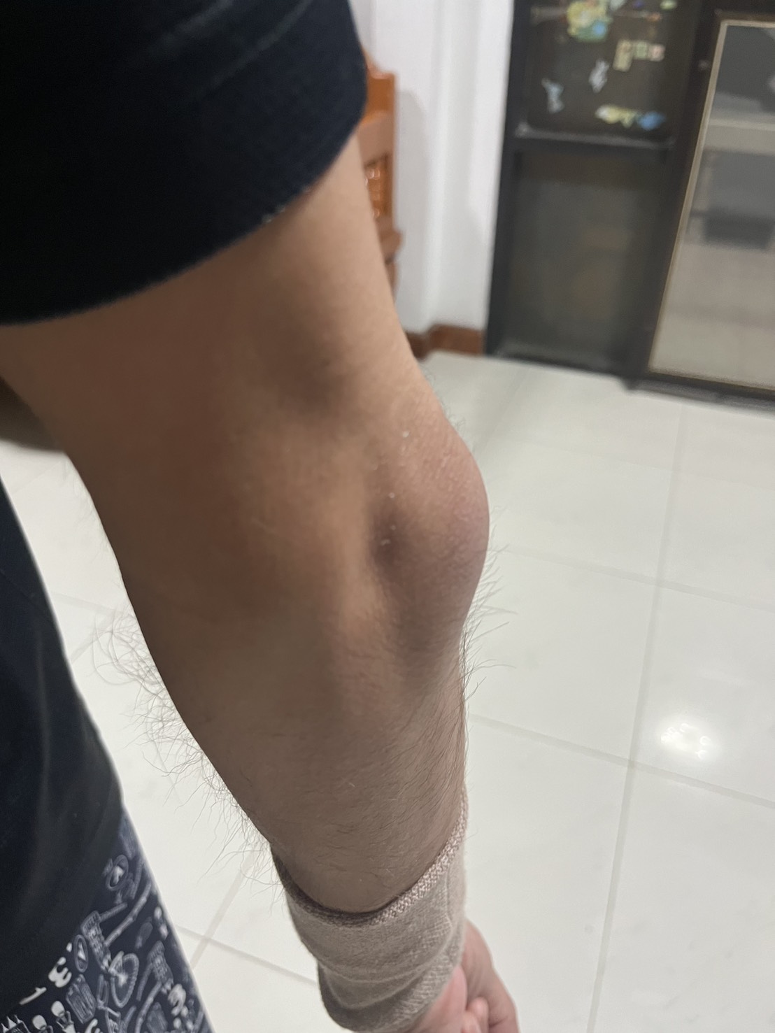 "ข้อศอกบวมปูดเหมือนมีลูกมะนาว" นิ่มแต่ไม่เจ็บ... ถุงน้ำหลังข้อศอกอักเสบ เรื่องใกล้ตัวของคนชอบเท้าแขน!