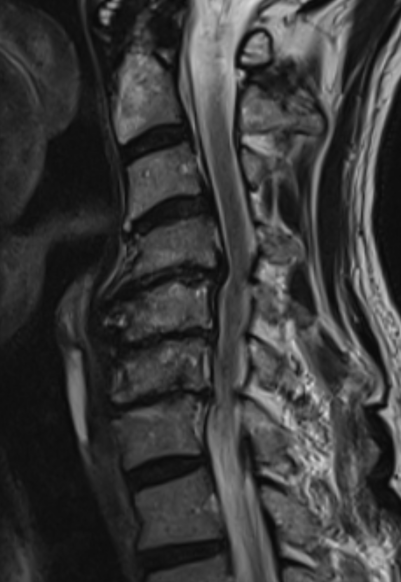 ปวดคอจนร้าวลงแขน... ผล MRI บอกว่าหมอนรองกระดูกเสื่อม ต้องผ่าตัดจริงหรือ?