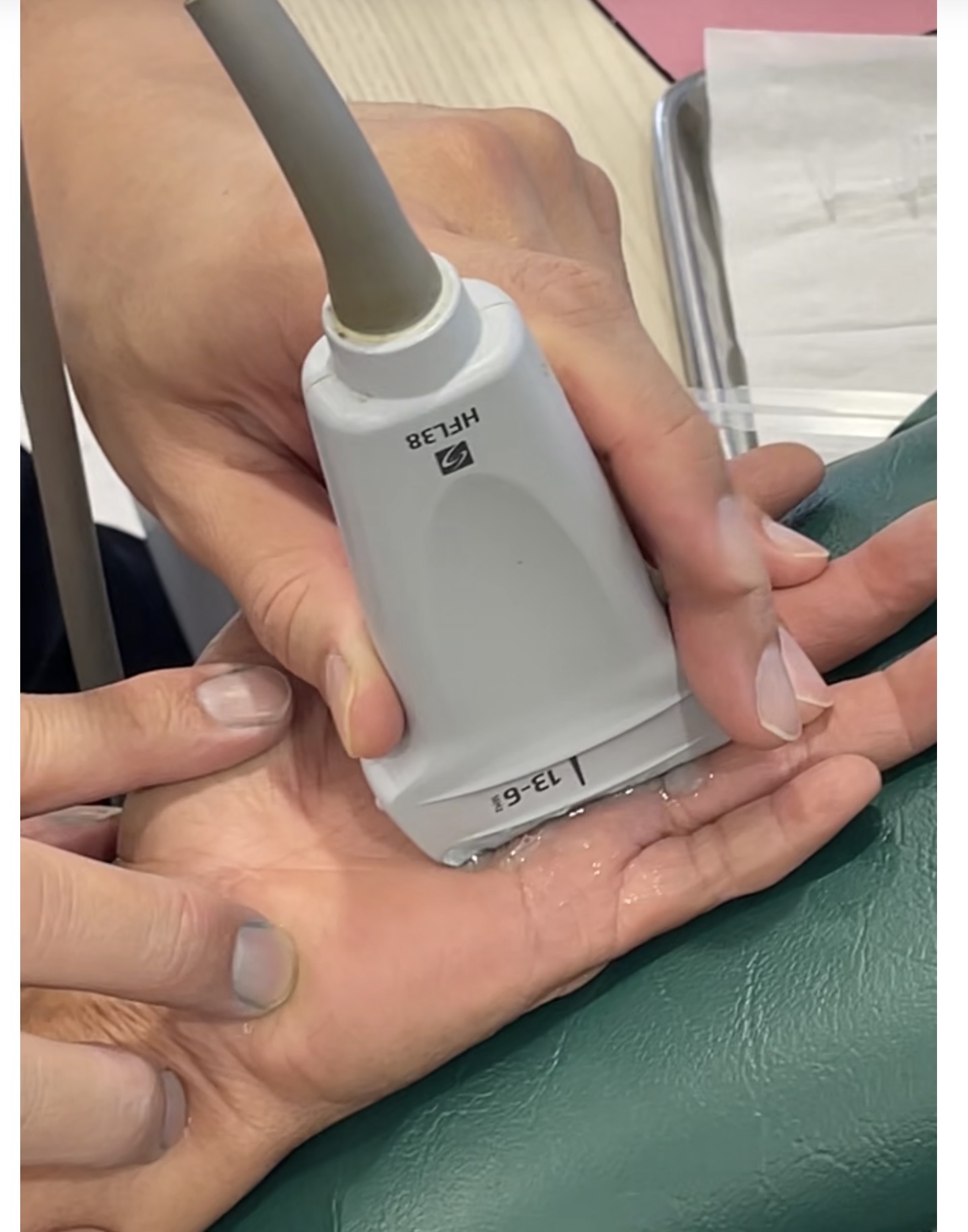 นิ้วงอติด ต้องใช้มืออีกข้างช่วยดึงให้ตรง รักษานิ้วล็อคด้วยเข็มเล็ก เจ็บน้อย กลับบ้านได้เลย