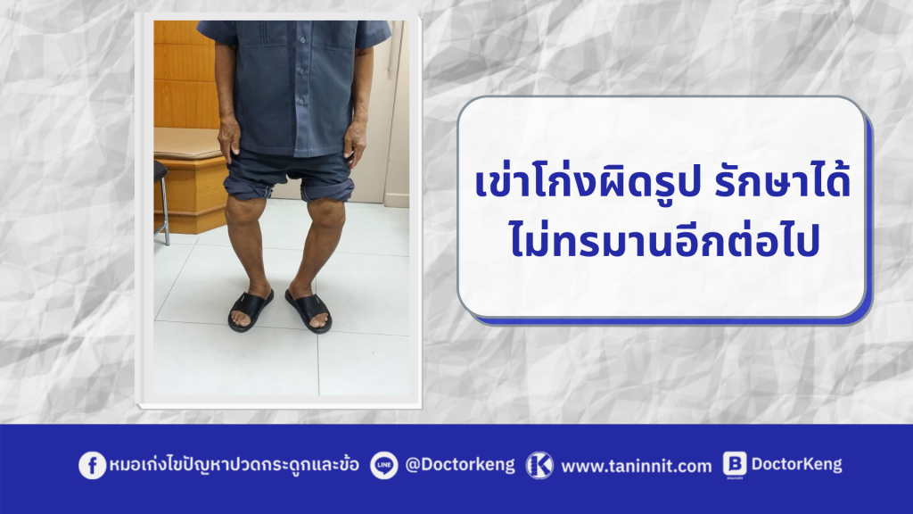 เข่าโก่งผิดรูป รักษาได้ ไม่ทรมานอีกต่อไป