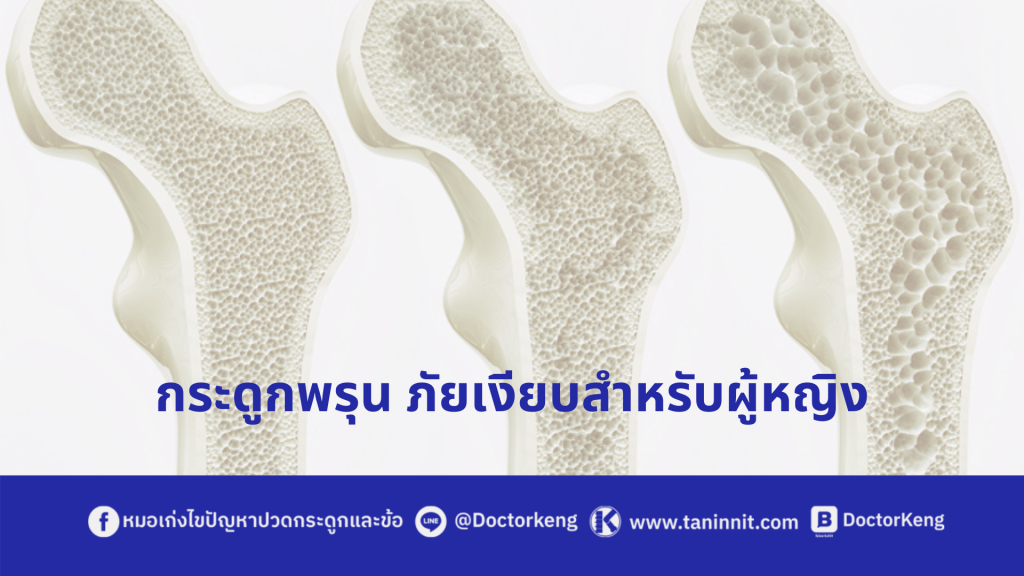 กระดูกพรุน ภัยเงียบสำหรับผู้หญิง