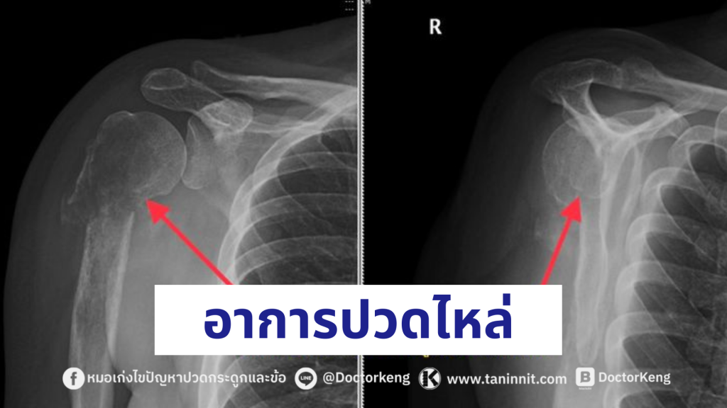 อาการปวดไหล่