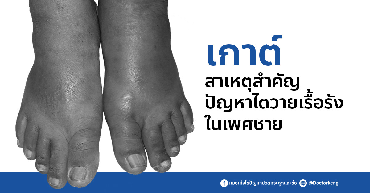 เกาต์สาเหตุสำคัญ ปัญหาไตวายเรื้อรัง ในเพศชาย