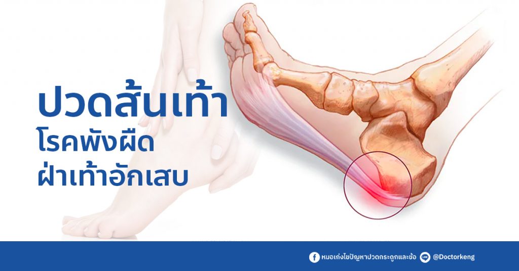 ปวดส้นเท้า โรคพังผืด ฝ่าเท้าอักเสบ